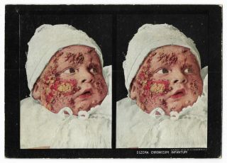 Antique 1910 Skin Disease Stereoview Card Medical Oddities Baby W/ Eczema