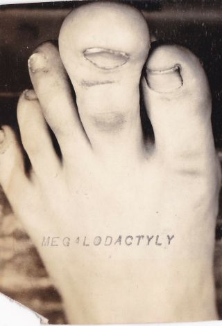 Vint Silver Photograph 1930 Unusual America Medical Big Toes Megalodactyly
