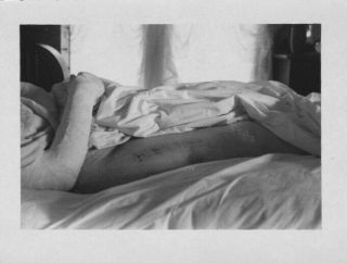 Vint Silver Photograph 1930 Unusual Medical Broken Leg? In Bed Recovery