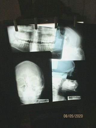 9 Vintage X - Rays 1970 